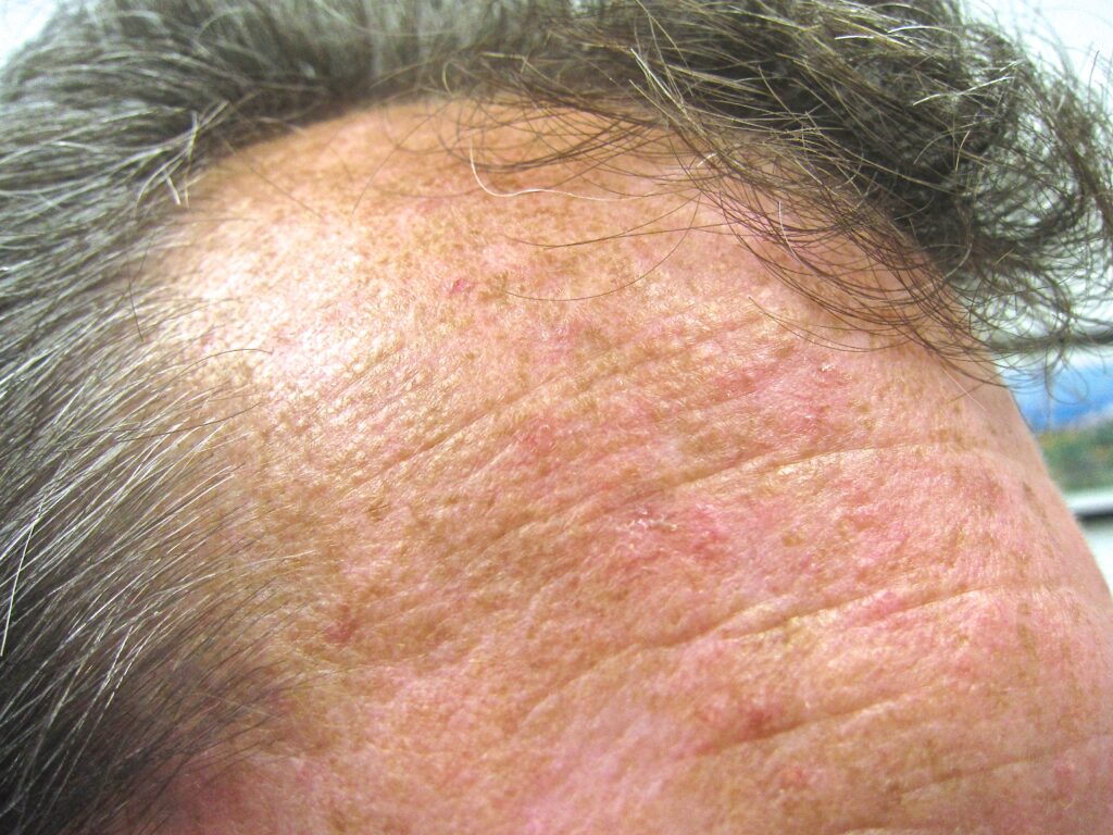 Actinic Keratosis – Central Wyoming Skin Clinic